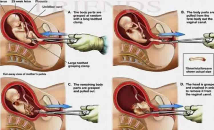 残忍的堕胎过程，堕胎的因果报应，看完你还要堕胎吗？-音狐运势网